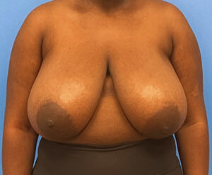 Breast-Reduction-Case--240 | Before Breast Reduction 1