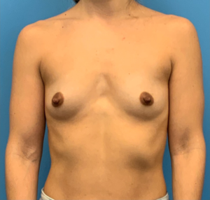 Breast-Augmentation-Case--24407 | Before Breast Augmentation 1