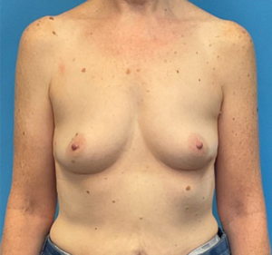 Breast-Augmentation-Case--27374 | Before Breast Augmentation 1
