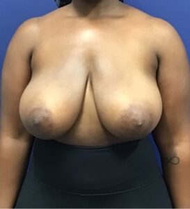 Breast-Reduction-Case--27530 | Before Breast Reduction 1