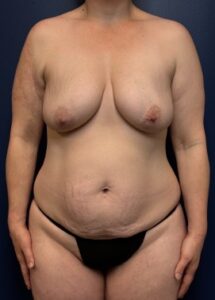 Tummy-Tuck-Case--9602 | Before Tummy Tuck 1