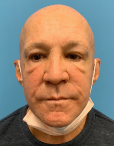 Blepharoplasty-Case--24169 | Before Eyelid Surgery 2