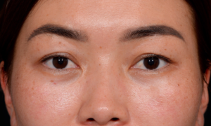 Blepharoplasty-Case--356 | Before Eyelid Surgery 1