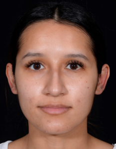 Rhinoplasty-Case--376 | Before Rhinoplasty 1
