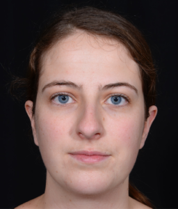 Rhinoplasty-Case--381 | Before Rhinoplasty 1