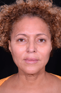 Facelift-Case--360 | Before Facelift 1