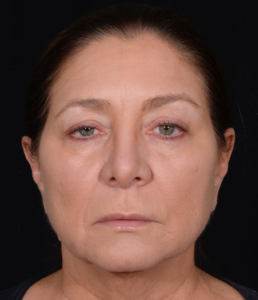 Blepharoplasty-Case--358 | Before Eyelid Surgery 1