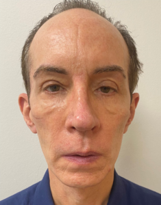 Blepharoplasty-Case--357 | Before Eyelid Surgery 1