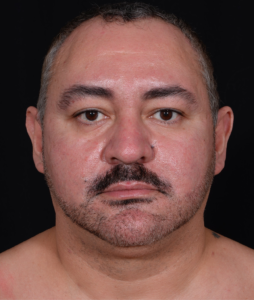 Liposuction-Case--368 | Before Submental Liposuction 1