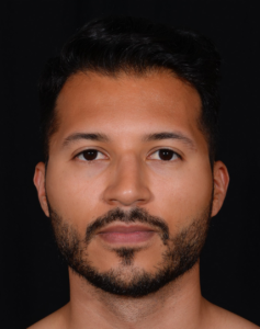 Rhinoplasty-Case--379 | Before Rhinoplasty 1