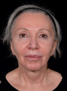 Facelift-Case--365 | Before Facelift 1