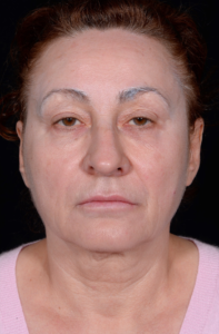 Facelift-Case--363 | Before Facelift 1