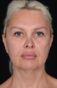 Facelift-Case--362 | Before Facelift 1