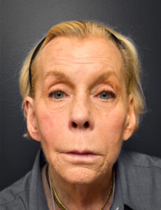 Facelift-Case--7247 | Before Facelift 1