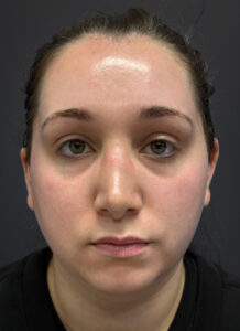 Submental-Liposuction-Case--3439 | Before Submental Liposuction 1