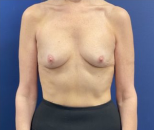 Subfascial-Breast-Augmentation-Case--26649 | Before Breast Augmentation 1
