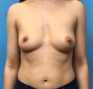 Breast-Augmentation-Case--226 | Before Breast Augmentation 1