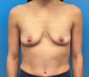 Breast-Augmentation-Mastopexy-Case--25025 | Before Breast Augmentation With Lift 1