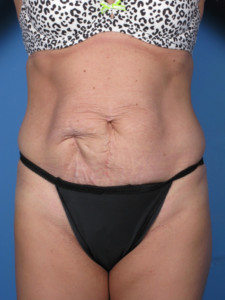 Tummy-Tuck-Case--250 | Before Tummy Tuck 1