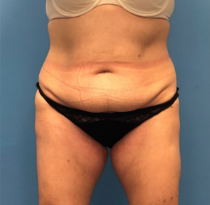 Case--251 | Before Liposuction 1