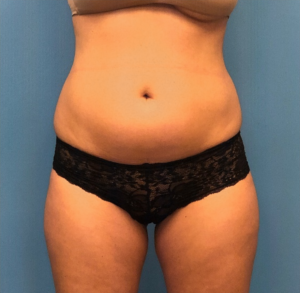 Lipo-360-Case--277 | Before Liposuction 1