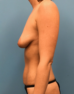 Mommy-Makeover-Case--41 | Before Mommy Makeover 2