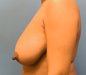 Breast-Reduction-Case--131 | Before Breast Reduction 2