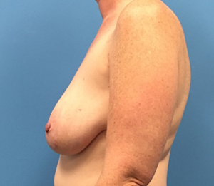 Case--137 | Before Breast Reconstruction 2