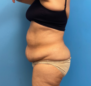 Tummy-Tuck-Case--27602 | Before Liposuction 2