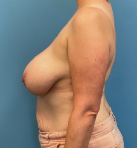 Breast-Reduction-Case--27625 | Before Breast Reduction 2