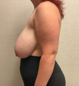 Breast-Reduction-Case--28338 | Before Breast Reduction 2