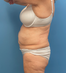 Liposuction-Tummy-Tuck-Case--23690 | Before Liposuction 2