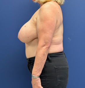 Breast-Reduction-Case--29091 | Before Breast Reduction 2