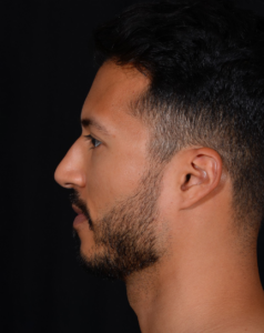 Rhinoplasty-Case--379 | Before Rhinoplasty 2