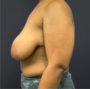 Breast-Reduction-Case--5320 | Before Breast Reduction 2