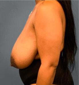 Breast-Reduction-Case--2564 | Before Breast Reduction 2