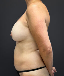 Mastopexy-Case--1663 | Before Breast Lift 2