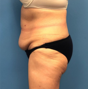 Case--251 | Before Liposuction 2