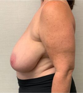 Breast-Reduction-Case--26425 | Before Breast Reduction 2