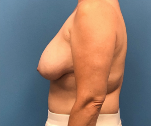 Breast-Reconstruction-Case--308 | Before Breast Reconstruction 2