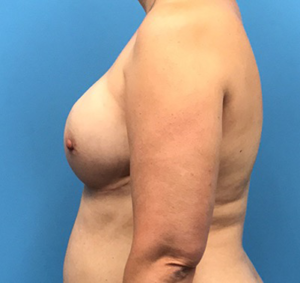 Case--136 | Before Breast Reconstruction 2