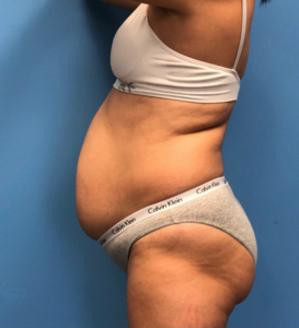 Case--14819 | Before Liposuction 2