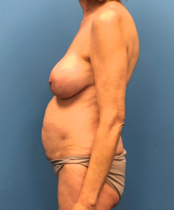 Case--17297 | Before Breast Lift 2