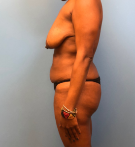 Mommy-Makeover-Case--13869 | Before Mommy Makeover 2