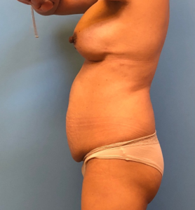 Case--11542 | Before Breast Reconstruction 2