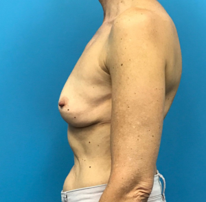 Revision-Augmentation--13287 | Before Revision Augmentation 2