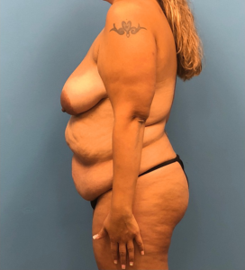 Lipoabdominoplasty-Breast-Augmentation-Case--15133 | Before Mommy Makeover 2