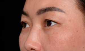 Blepharoplasty-Case--356 | Before Eyelid Surgery 2