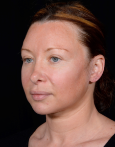 Facelift-Case--355 | Before Facelift 2