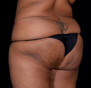 Brazilian-Butt-Lift-Case--352 | Before Brazilian Butt Lift 1